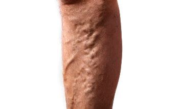 big bulging|5 Causes For Bulging Veins and Why You Should Treat Them.